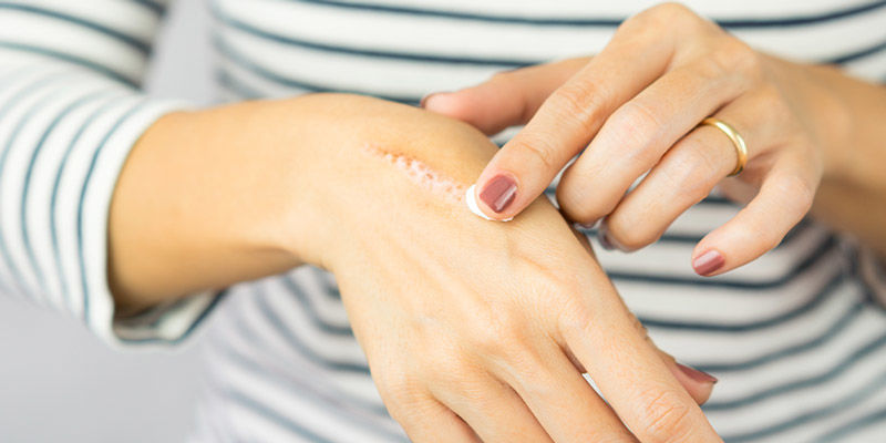 Poparzenie się lub złapanie gołej główki Poparzenie się lub złapanie gołej główki