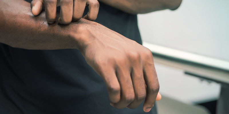 Objawy alergii na konopie Objawy alergii na konopie