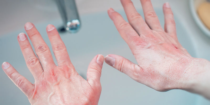 Jak złagodzić pieczenie skóry po ostrych papryczkach? Jak złagodzić pieczenie skóry po ostrych papryczkach?