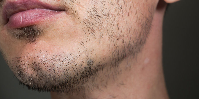 Kannabinoidy, poziom testosteronu i porost włosów Kannabinoidy, poziom testosteronu i porost włosów