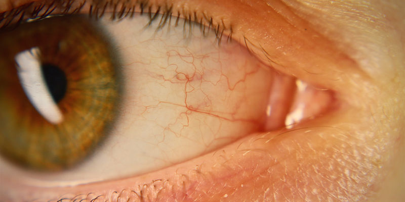 Red Or Bloodshot Eyes Red Or Bloodshot Eyes